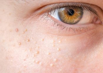 Da sần dưới mắt như gà bị nhổ lông là do đâu?