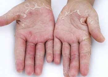 Bị lột da tay có ảnh hưởng gì không?