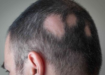 Rụng tóc mảng: Nguyên nhân, triệu chứng và điều trị