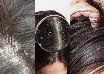 Hướng dẫn khắc phục tình trạng tóc nhiều gàu bằng những cách đơn giản