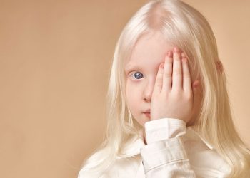 Bệnh bạch tạng xuất hiện do đâu? Những dấu hiệu nhận biết cơ bản