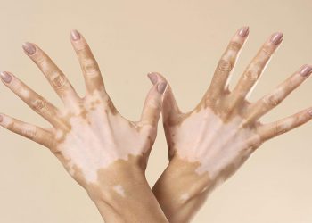 Bạch biến là gì? Những nguyên nhân và triệu chứng nhận biết bệnh