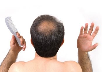 Góc giải đáp: Chữa hói đầu bằng cách nào?