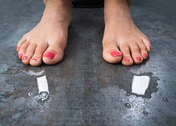 Những điều bạn cần biết về hội chứng đổ mồ hôi tay chân