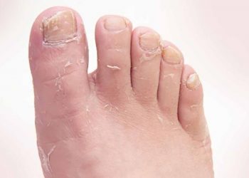 Biểu hiện của nấm bàn chân và hướng dẫn cách điều trị hiệu quả