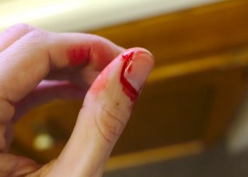 Bị lật móng tay vì những lý do nào và một số hướng dẫn xử trí hiệu quả