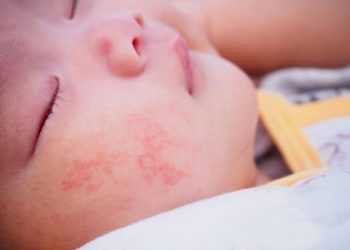 Những triệu chứng của viêm da dị ứng tiếp xúc và cách phòng ngừa bệnh