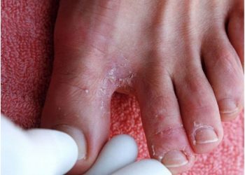 Từ A đến Z những điều bạn cần biết về bệnh nấm kẽ bàn chân