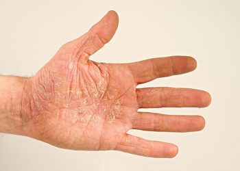 Từ điển Y khoa: Dấu hiệu nhận biết và cách phòng ngừa viêm da bong vảy