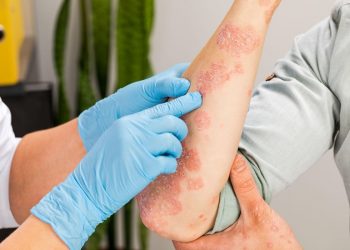 Viêm da cơ địa có nguy hiểm không? Điều trị bệnh bằng phương pháp nào?