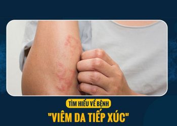 Thông tin cơ bản về bệnh viêm da tiếp xúc và mức độ nguy hiểm của bệnh