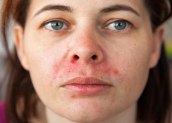 Bác sĩ chỉ cách điều trị bệnh viêm da tiết bã