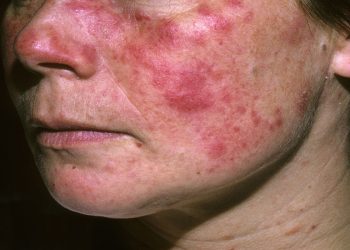 Lupus ban đỏ nguy hiểm như thế nào? Làm sao để phòng ngừa biến chứng?