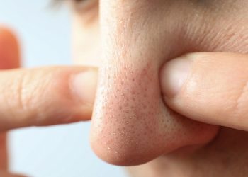 Loại bỏ mụn đầu đen ở mũi hiệu quả ngay tại nhà