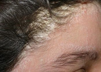 Nấm da đầu: Nguyên nhân do đâu? cách điều trị và phòng ngừa