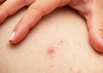 Viêm nang lông – Cẩm nang thông tin Y khoa cần biết!