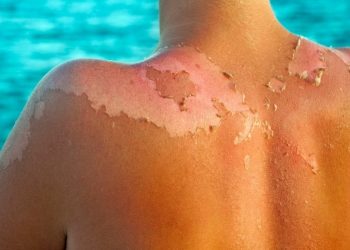 Góc tư vấn: Làm thế nào xử lý khi da bị cháy nắng?