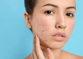 8 cách làn da phản ánh sự căng thẳng của bạn và cách bảo vệ da mà bạn nên biết