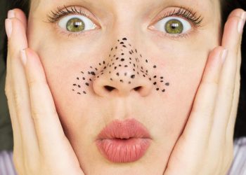 Gợi ý chu trình chăm sóc da trị mụn đầu đen và những lưu ý cần phải biết