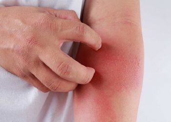 Viêm da tiếp xúc là gì? Phương pháp điều trị cho người bệnh