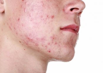 Nguyên nhân gây mụn trứng cá ở nam giới và cách điều trị