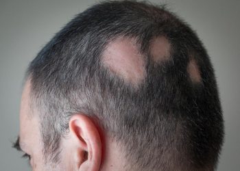Bệnh rụng tóc mảng là gì? Khắc phục như thế nào?
