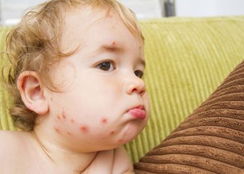 Thủy đậu ở trẻ em – Cẩm nang thông tin Y khoa cần biết