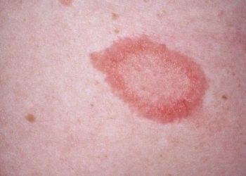 Bệnh vảy phấn hồng là gì? Cách điều trị bệnh an toàn và hiệu quả