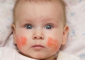 Bệnh chàm sữa là gì? Những điều quan trọng cha mẹ nên biết