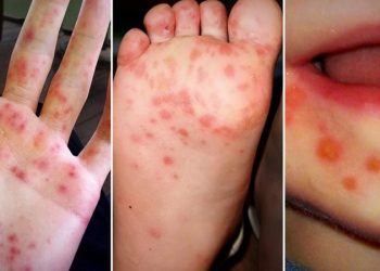 Bệnh tay chân miệng: Nguyên nhân, dấu hiệu nhận biết và cách điều trị