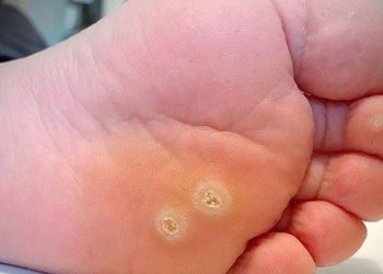 Điểm danh các loại thuốc trị mụn cóc hiệu quả và an toàn