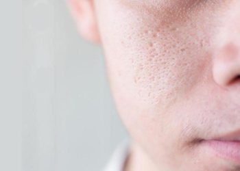 Cách điều trị sẹo rỗ để lấy lại vẻ mịn màng cho làn da