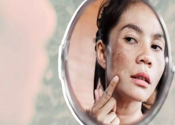Nguyên nhân gây nám da và các phương pháp điều trị