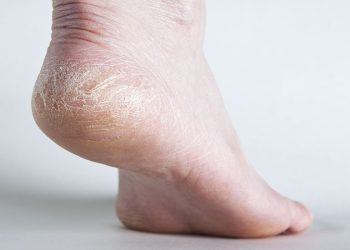 Nứt gót chân do đâu và cách khắc phục hiệu quả