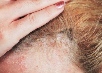 Bệnh vảy nến da đầu nguyên nhân do đâu?