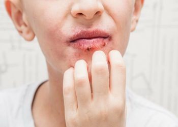 Viêm da quanh miệng nguyên nhân do đâu và cách điều trị