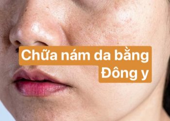 Chữa nám da theo Đông y