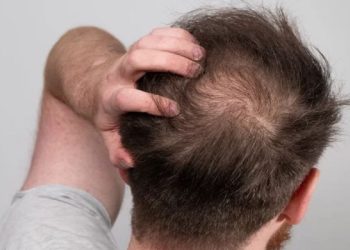 Viêm nang tóc do đâu và cách điều trị?