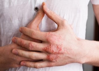 Viêm da bàn tay và những điều bạn cần biết