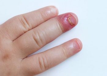 Đi tìm nguyên nhân gây viêm quanh móng và cách điều trị