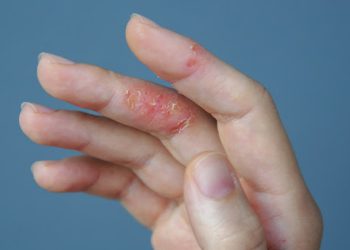 Thuốc bôi viêm da cơ địa dùng sao cho hiệu quả, an toàn?
