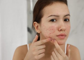 Công dụng của thuốc trị sẹo thâm do mụn và ưu nhược điểm của từng loại