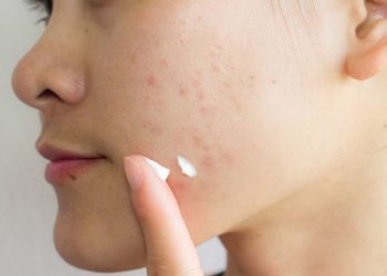 Lựa chọn thuốc trị thâm mụn bôi ngoài da hiệu quả