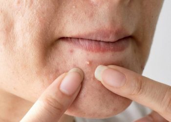 Ăn gì để hết mụn – 8 thực phẩm đánh bay mụn bạn nên thử!