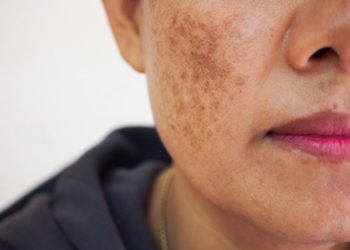 Nám da là gì? Gợi ý 6 cách trị nám da tại nhà nên thử!