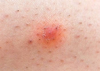 Hiện tượng lông mọc ngược và những lưu ý dành cho bạn
