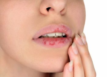Chàm môi là gì, nguyên nhân và cách điều trị
