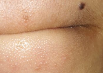 Trị mụn cám ở cằm từ những nguyên liệu quen thuộc