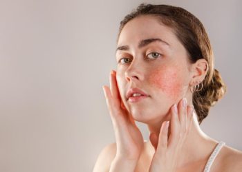 Vết chàm trên da xuất hiện do đâu? xử lý thế nào?