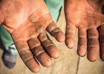 Chai da là gì? 5 phương pháp cải thiện hiệu quả